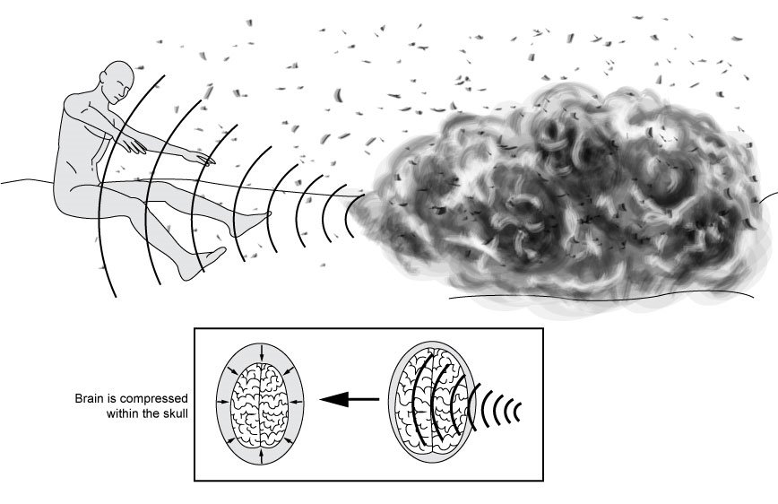 A black and white illustration showing an explosion (right), its blast radius and the force from it blowing back a human form (left). In a rectangle below the image shows a top view of a normal brain during the blast (right) and then a top view of the brain after the blast, showing brain compression or blast injury (left).