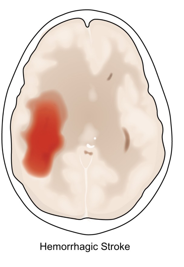 A top view illustration (similar to an MRI scan film) of a Hemorrhagic Stroke. The brain is colored light pink and the hemorrhagic stroke is highlighted in red