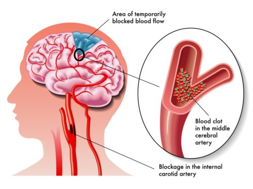A silhouette of a human head, facing left, with an image of a brain, various arteries and the carotid arteries and a blood clot, layered within the human head silhouette. An oval containing an enlarged illustration of a blood clot in the cerebral artery within the brain is off to the right. Descriptive words surround both illustratio