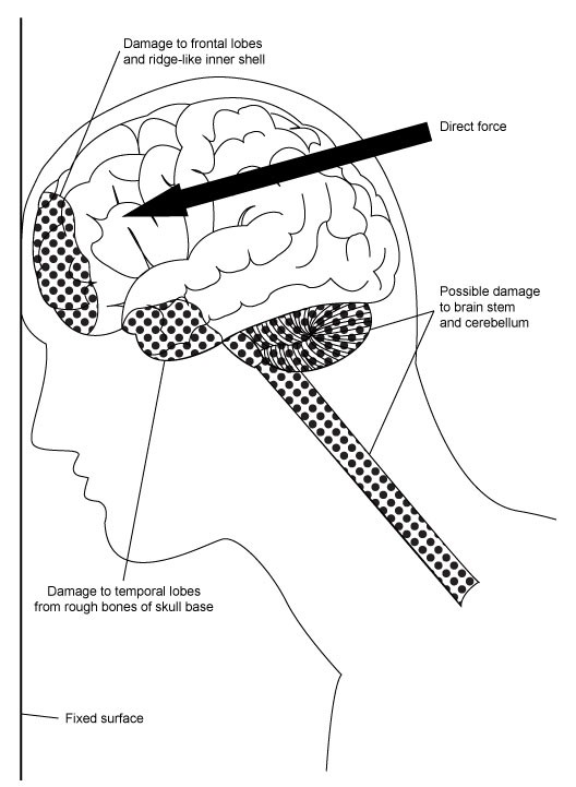 Diffused Axonal Injury, Concussion effects diagram.